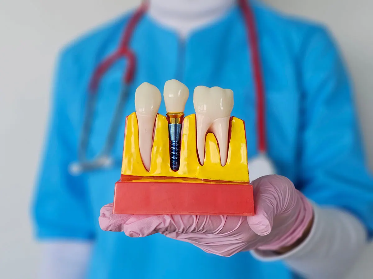 Dental Implants