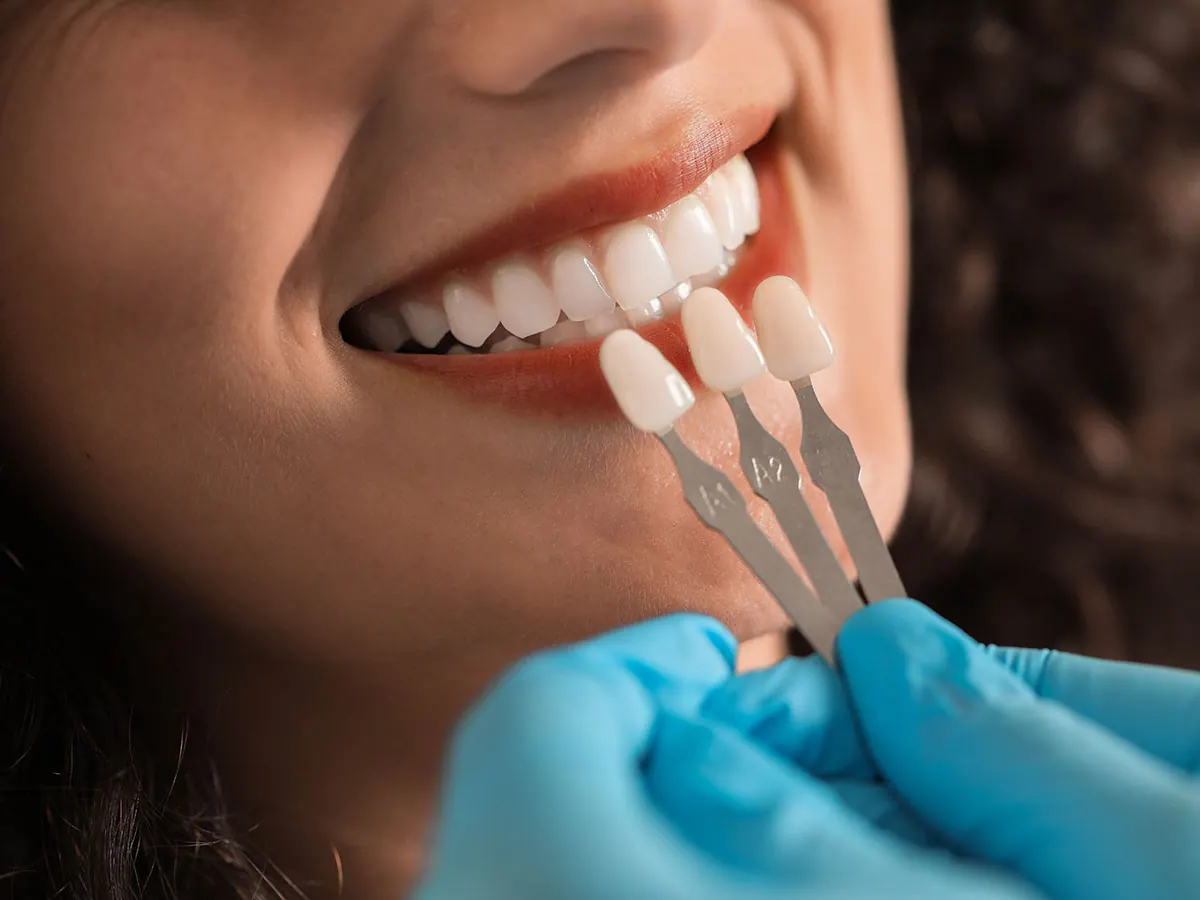 Veneers